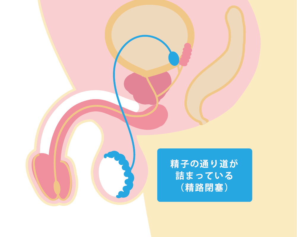 精路閉塞