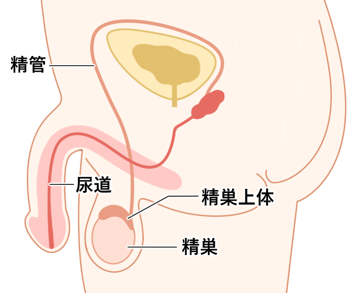 精巣上体炎