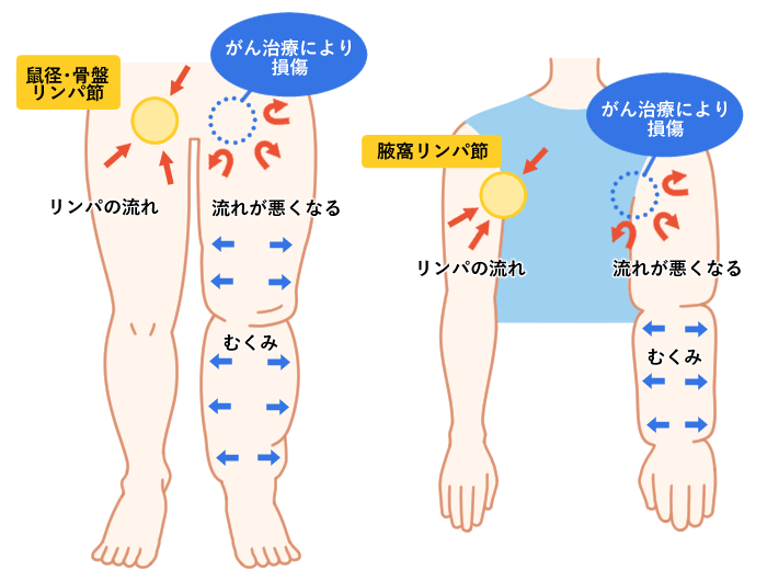 リンパ浮腫