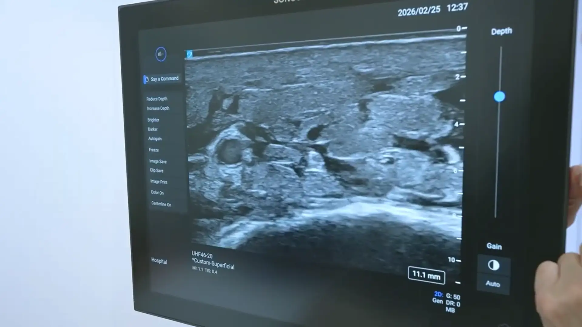 Sonosite LXによるリンパ管の超音波画像